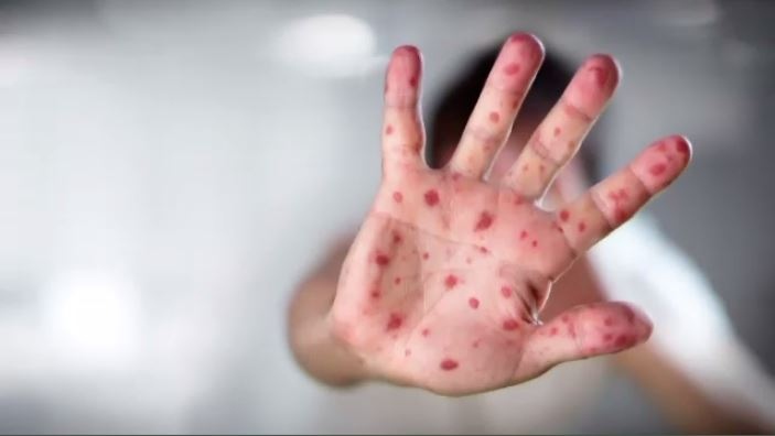 As the U.K. warns of a possible measles outbreak, a Toronto doctor is urging Canada to take steps to prevent a similar scenario here.