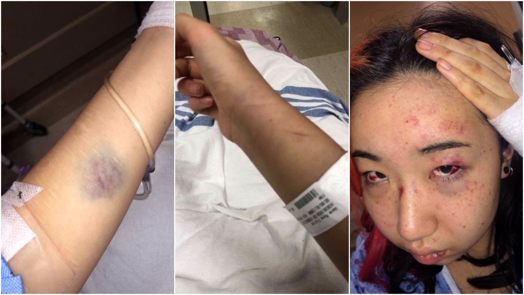 Injuries alleged by Mona Wang to be the result of an encounter with a Kelowna, B.C. RCMP officer are shown in provided images. 